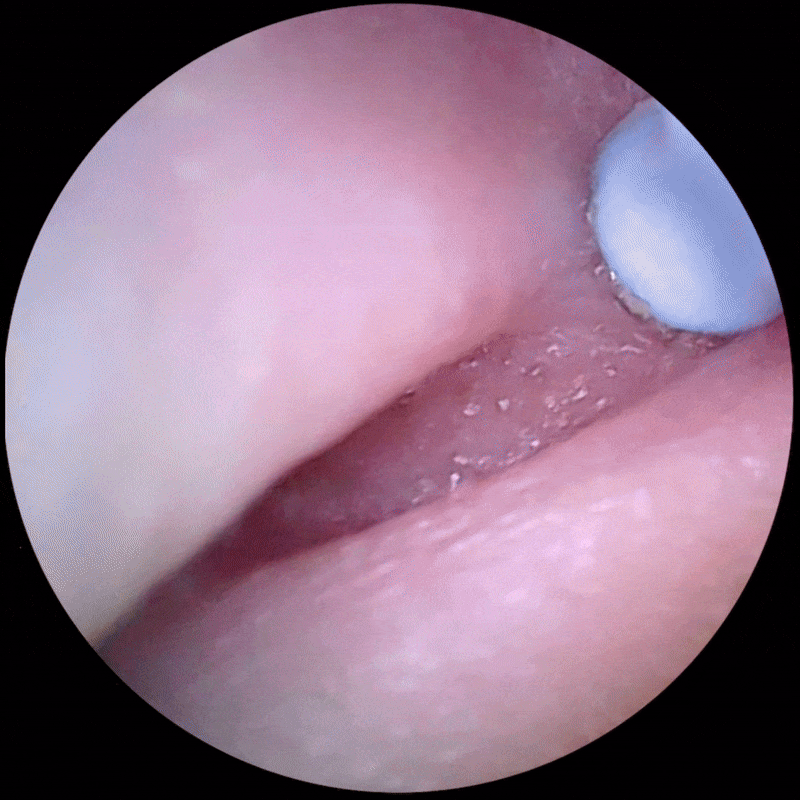 Close-up view inside a textured pink surface with a blue-white object.