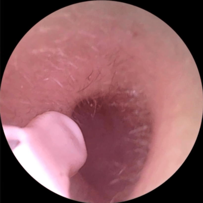 Close-up of a human ear canal with visible ear hair.