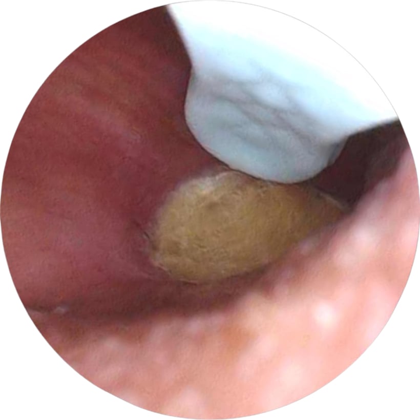 Close-up of a cotton swab near a yellowish patch inside an ear.