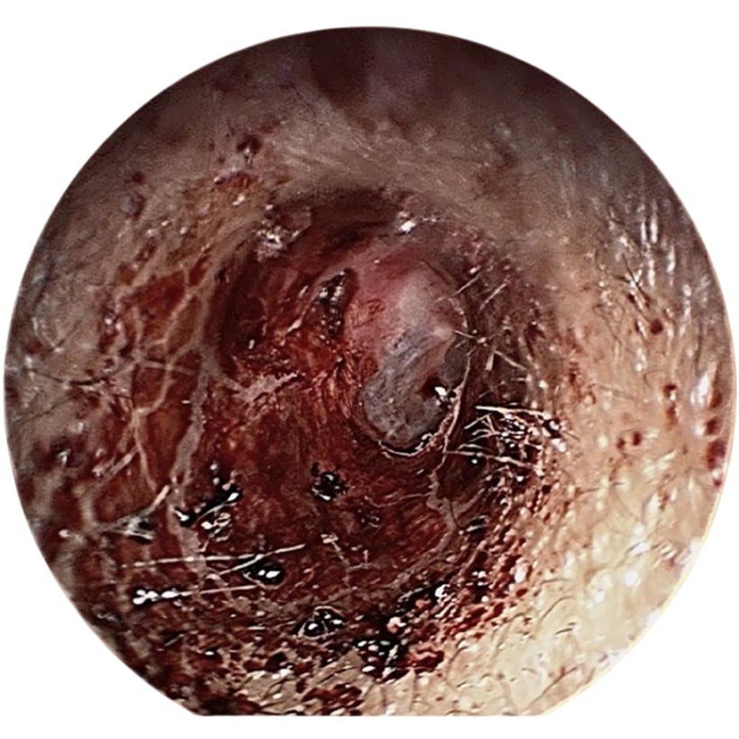 Close-up view of an ear canal with wax and debris.